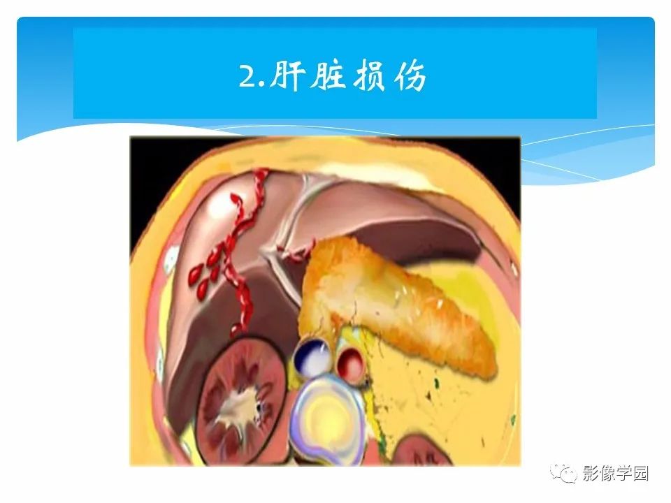 影像PPT - 【PPT】常见腹部外伤的影像诊断-43
