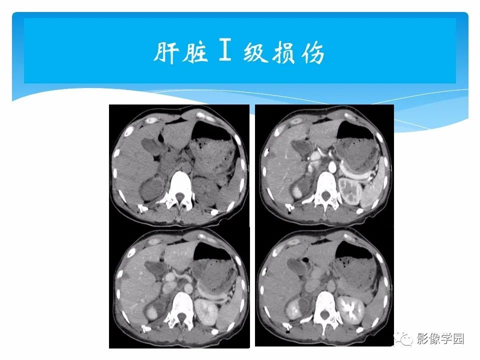 影像PPT - 【PPT】常见腹部外伤的影像诊断-45
