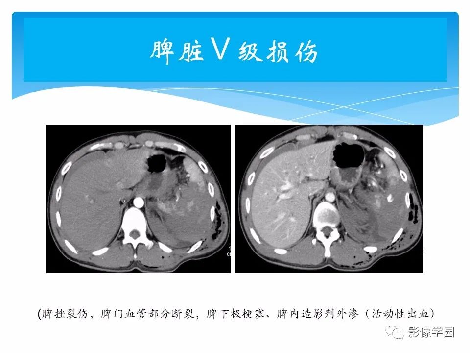 影像PPT - 【PPT】常见腹部外伤的影像诊断-42