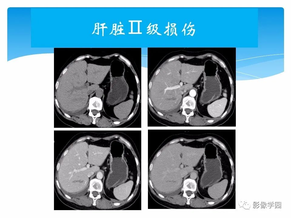 影像PPT - 【PPT】常见腹部外伤的影像诊断-46