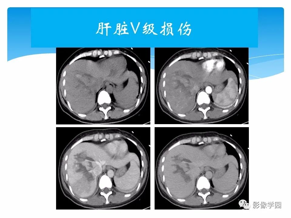 影像PPT - 【PPT】常见腹部外伤的影像诊断-49