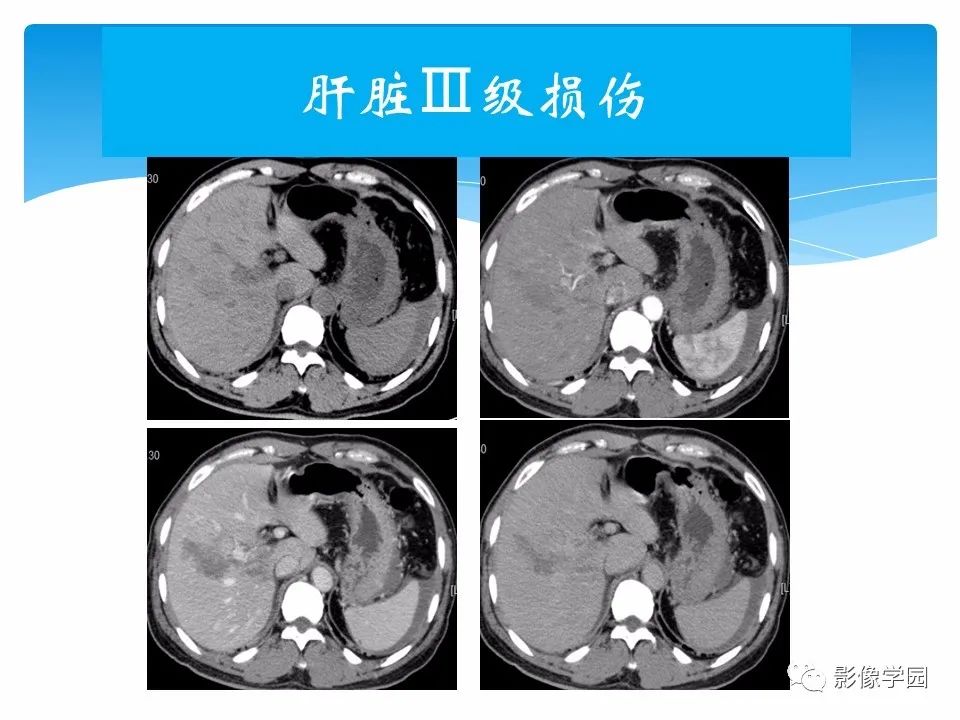 影像PPT - 【PPT】常见腹部外伤的影像诊断-47