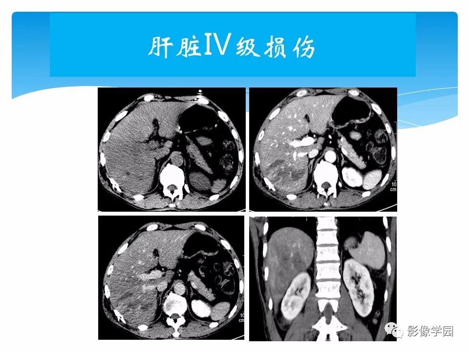 影像PPT - 【PPT】常见腹部外伤的影像诊断-48