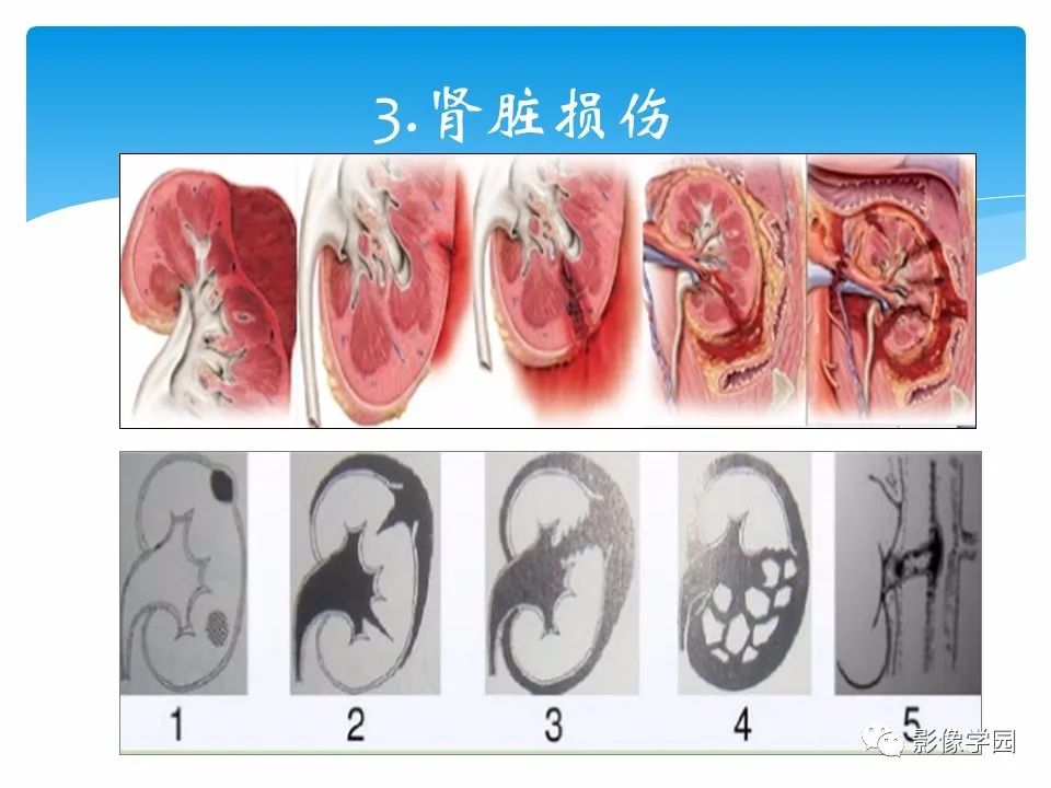 影像PPT - 【PPT】常见腹部外伤的影像诊断-50