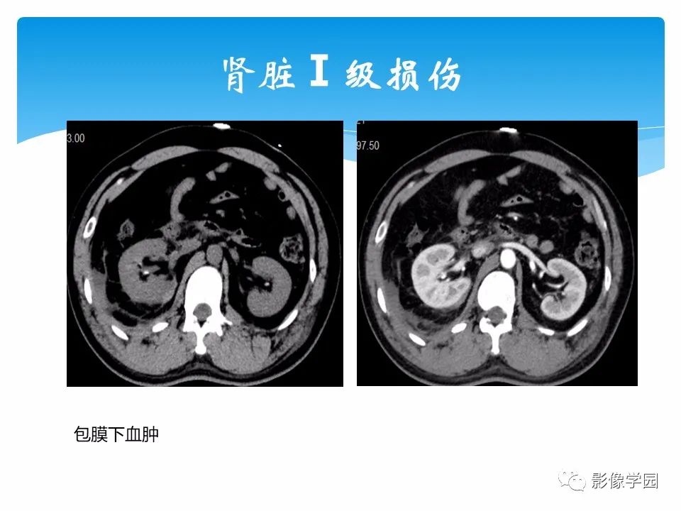 影像PPT - 【PPT】常见腹部外伤的影像诊断-52