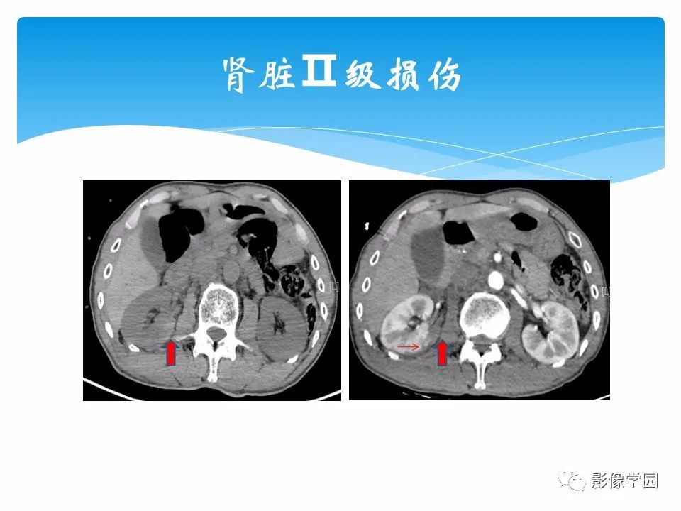 影像PPT - 【PPT】常见腹部外伤的影像诊断-53