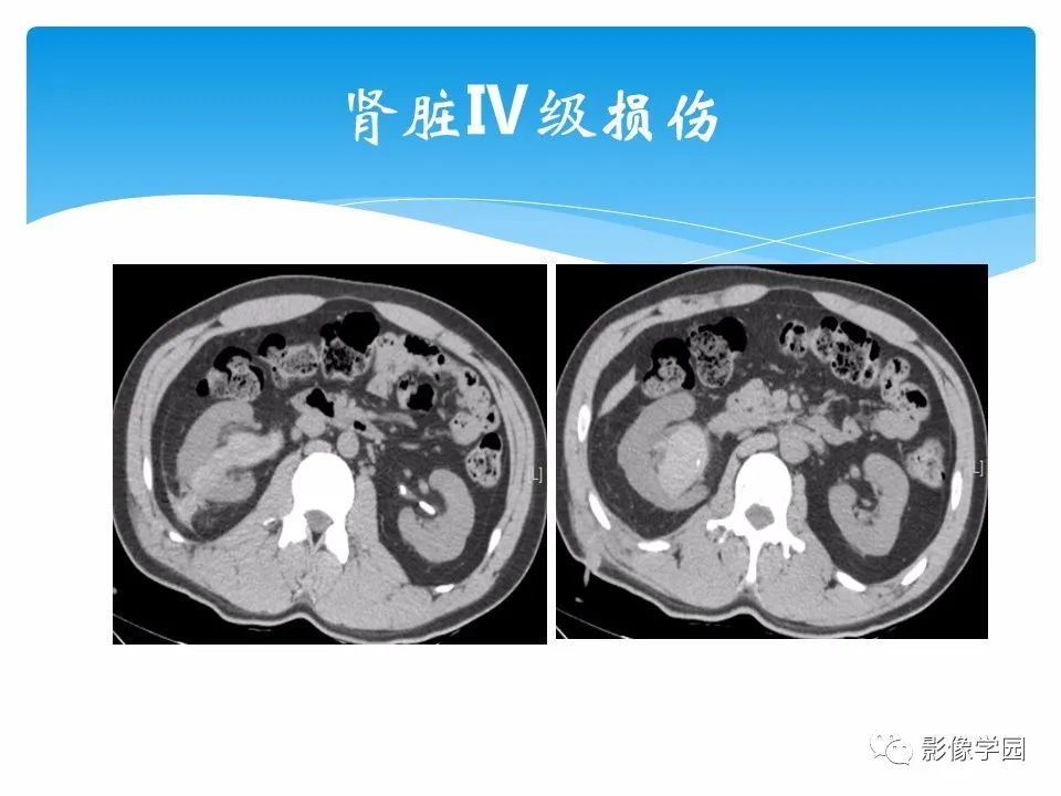 影像PPT - 【PPT】常见腹部外伤的影像诊断-55