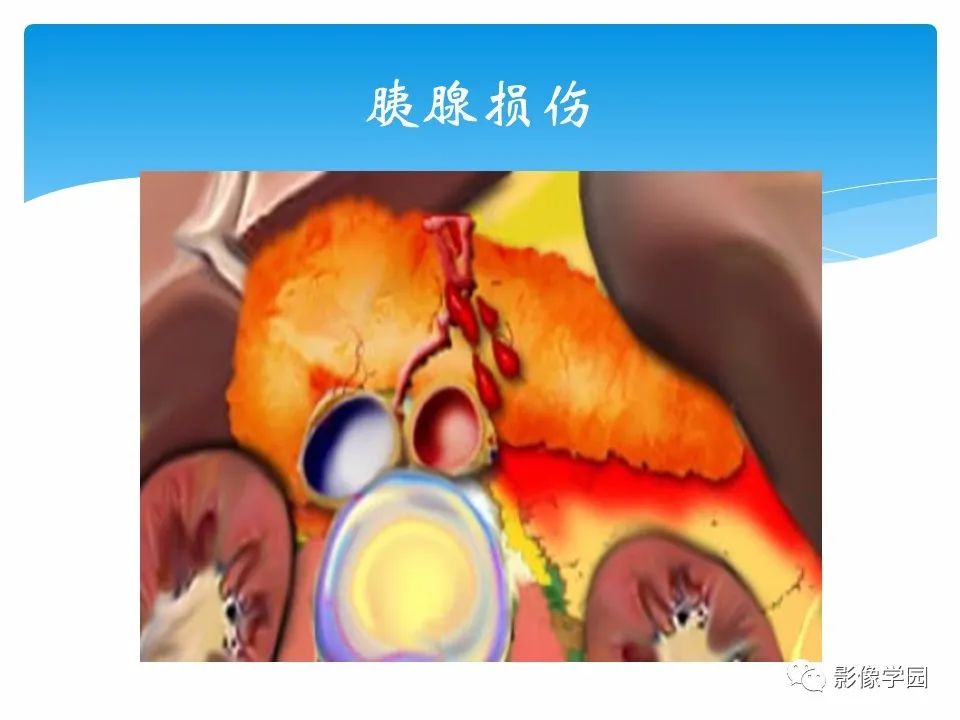 影像PPT - 【PPT】常见腹部外伤的影像诊断-57
