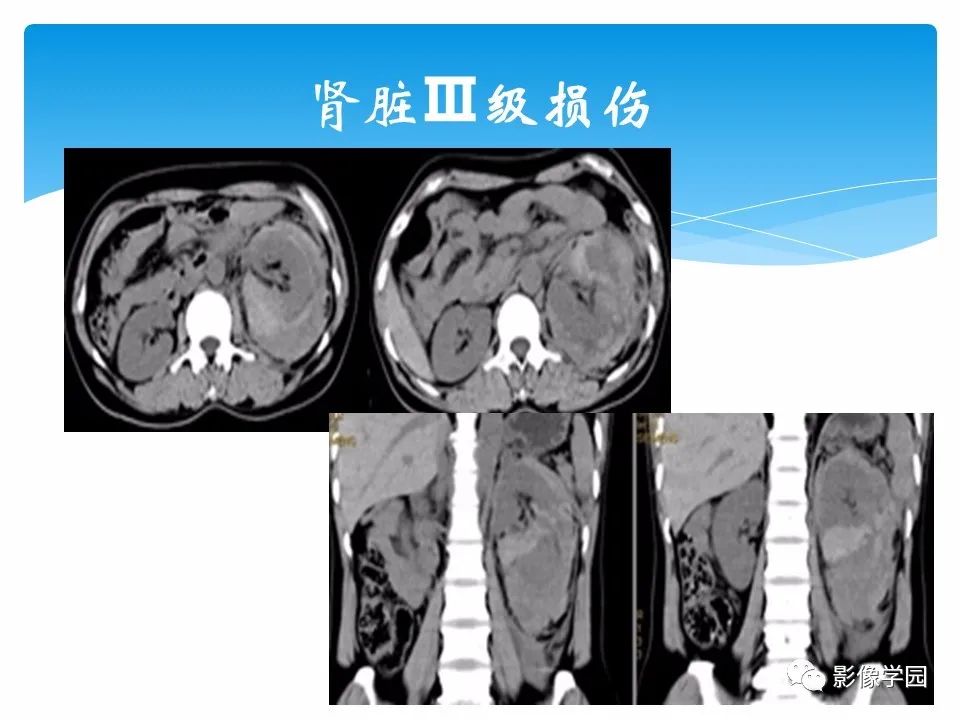 影像PPT - 【PPT】常见腹部外伤的影像诊断-54
