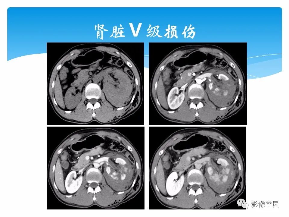 影像PPT - 【PPT】常见腹部外伤的影像诊断-56