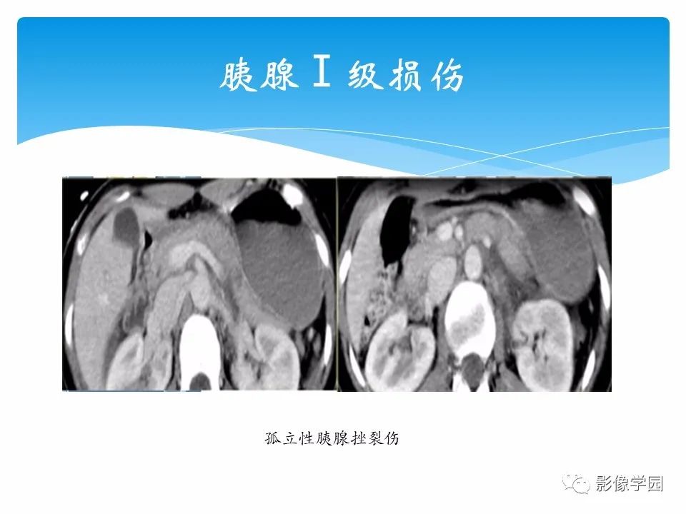 影像PPT - 【PPT】常见腹部外伤的影像诊断-60