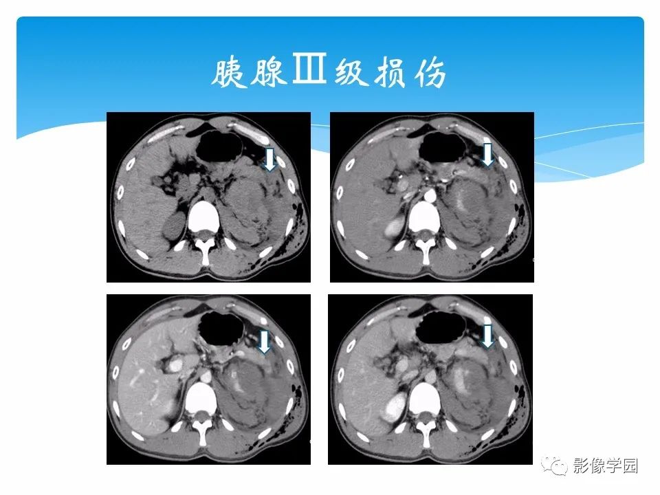 影像PPT - 【PPT】常见腹部外伤的影像诊断-62
