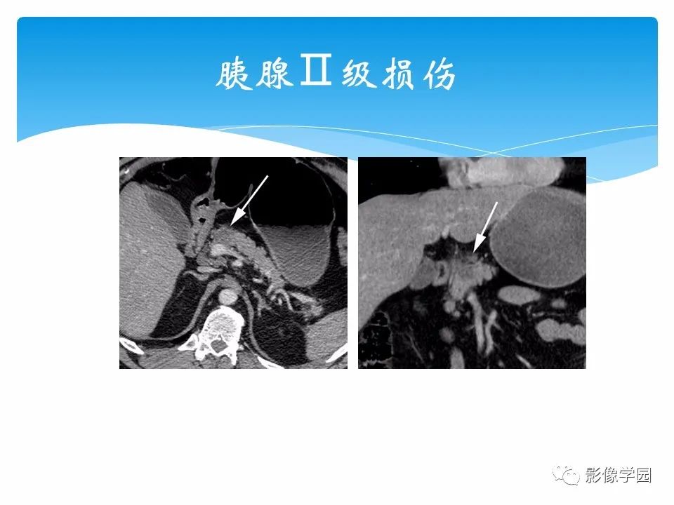 影像PPT - 【PPT】常见腹部外伤的影像诊断-61