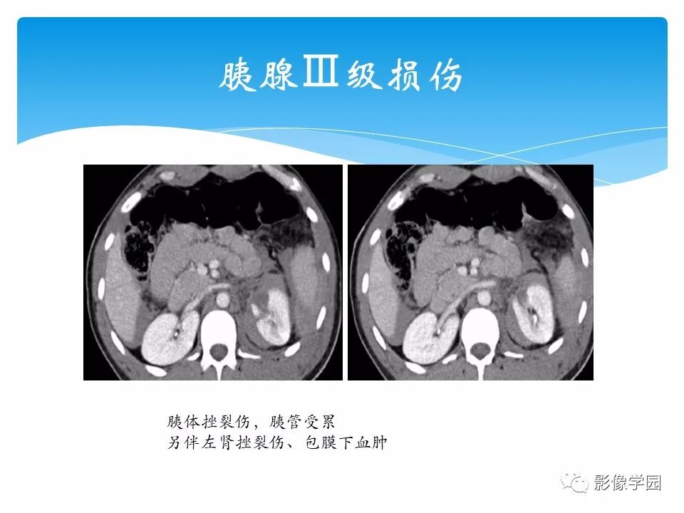 影像PPT - 【PPT】常见腹部外伤的影像诊断-63