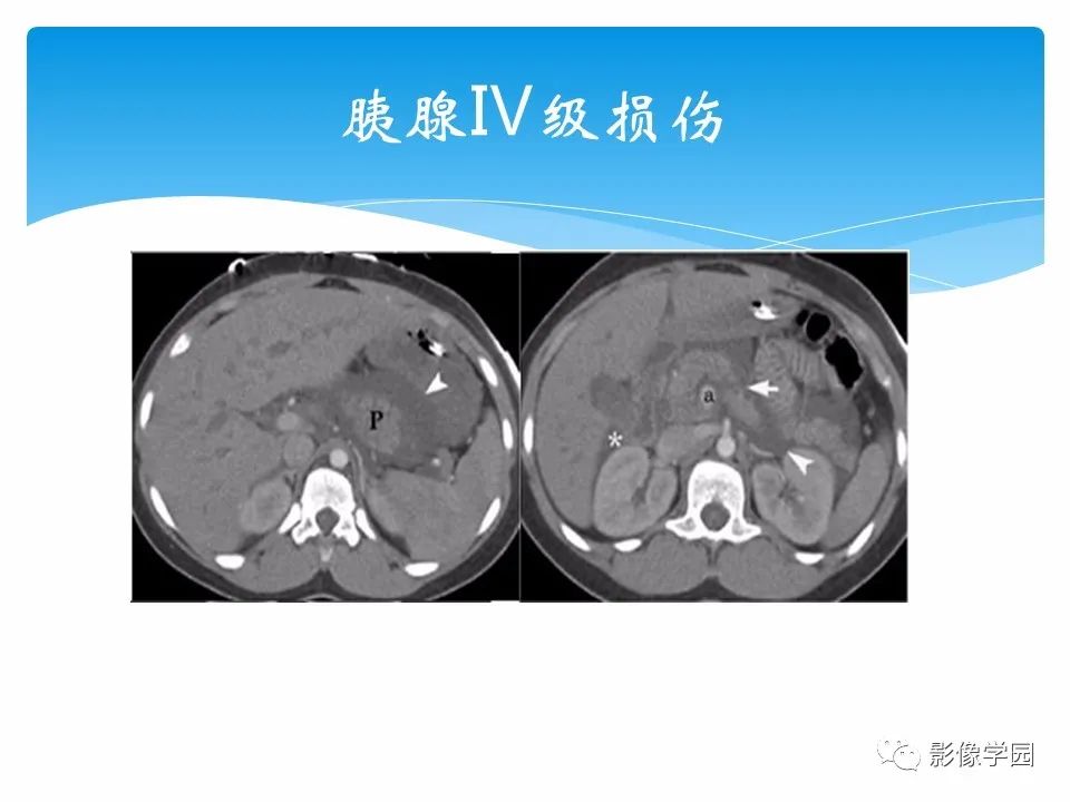 影像PPT - 【PPT】常见腹部外伤的影像诊断-64