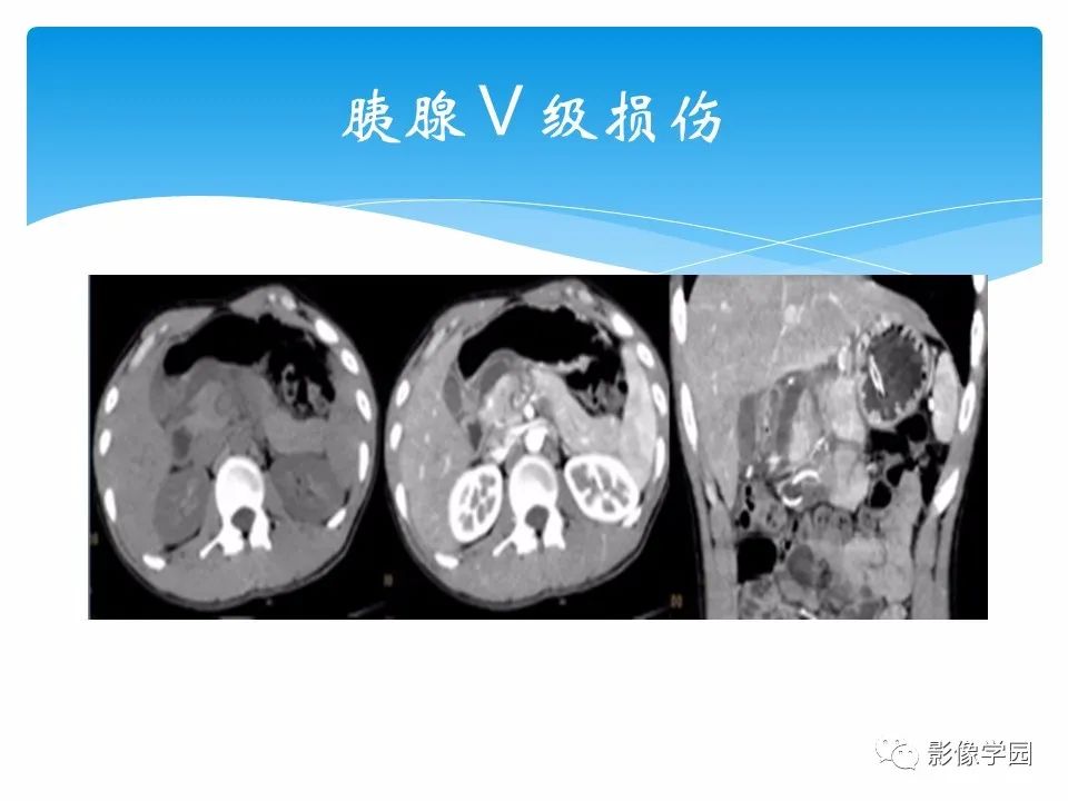 影像PPT - 【PPT】常见腹部外伤的影像诊断-65