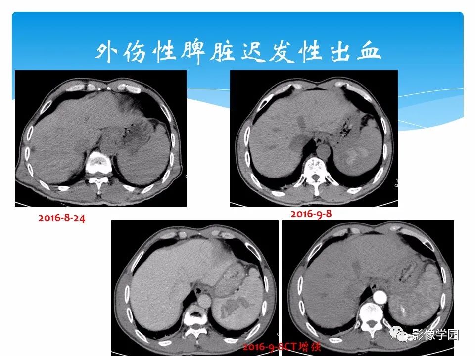 影像PPT - 【PPT】常见腹部外伤的影像诊断-73
