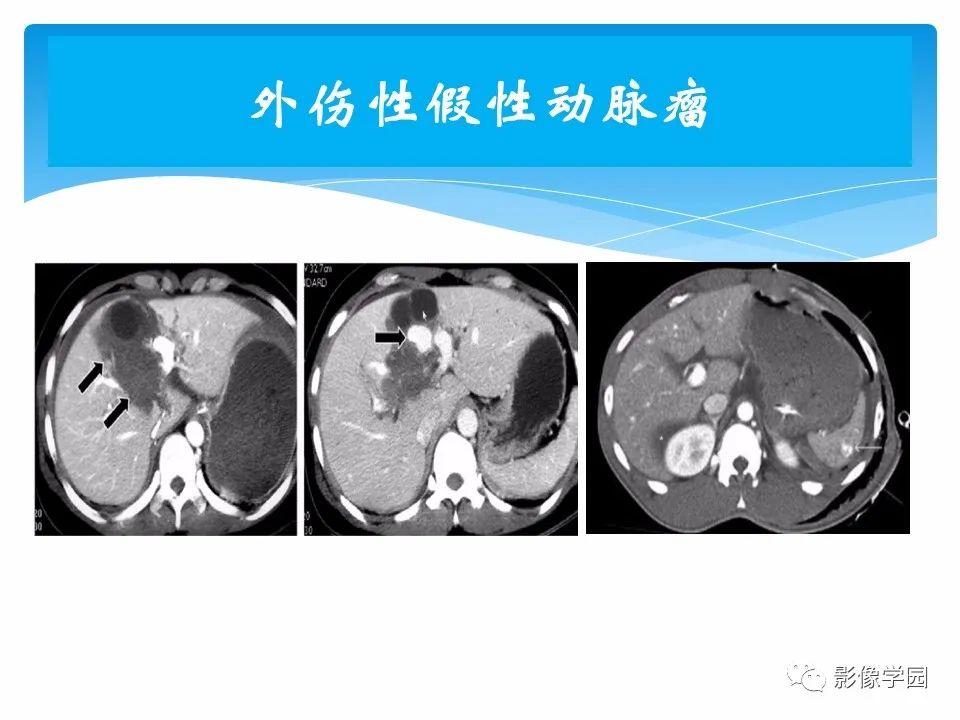 影像PPT - 【PPT】常见腹部外伤的影像诊断-71
