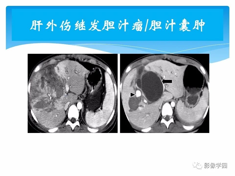 影像PPT - 【PPT】常见腹部外伤的影像诊断-70