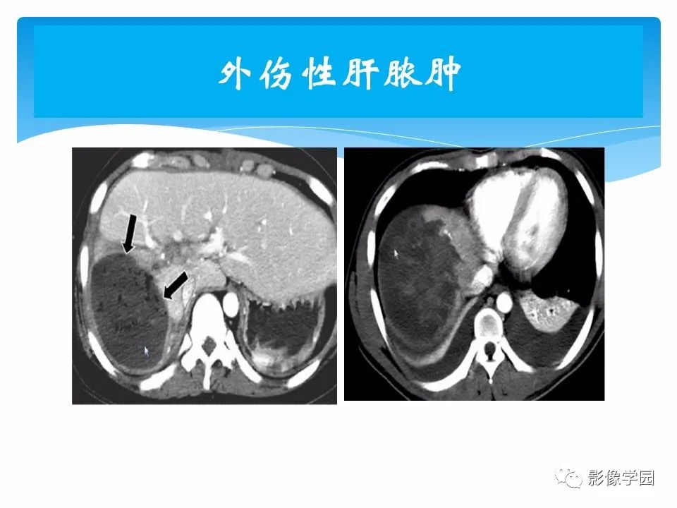 影像PPT - 【PPT】常见腹部外伤的影像诊断-69