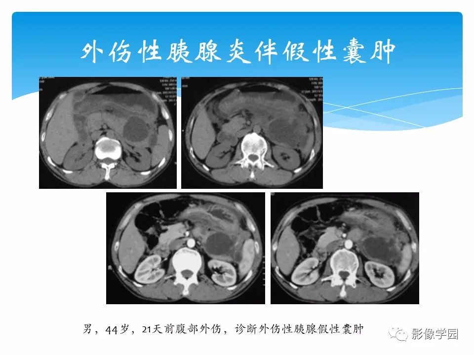影像PPT - 【PPT】常见腹部外伤的影像诊断-72