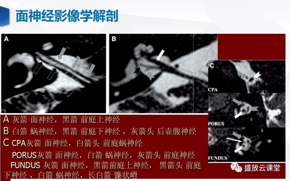 影像PPT - 【PPT】面神经MR评估-7