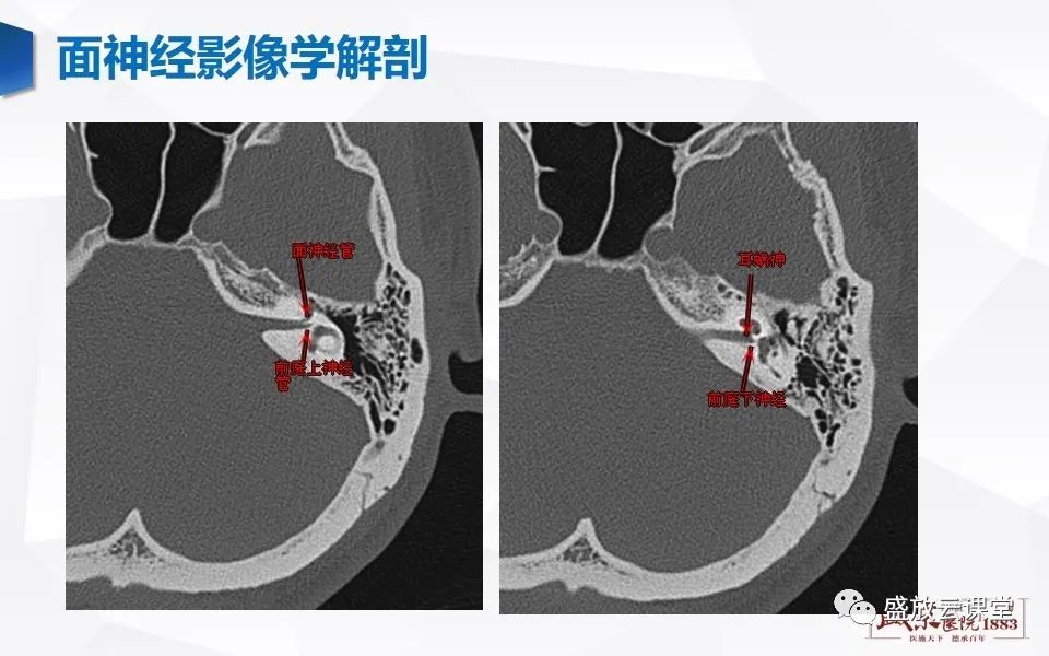 影像PPT - 【PPT】面神经MR评估-8
