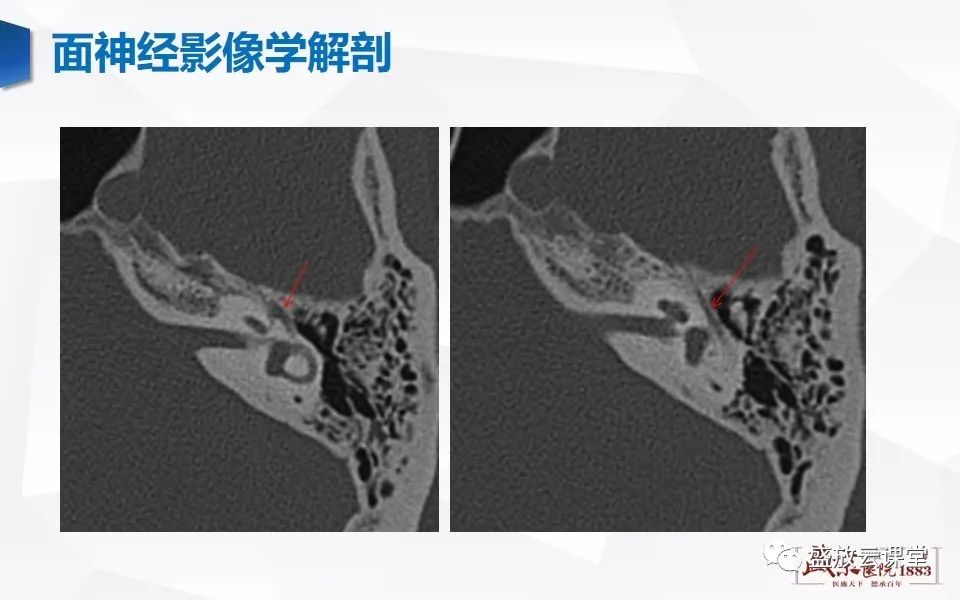 影像PPT - 【PPT】面神经MR评估-9