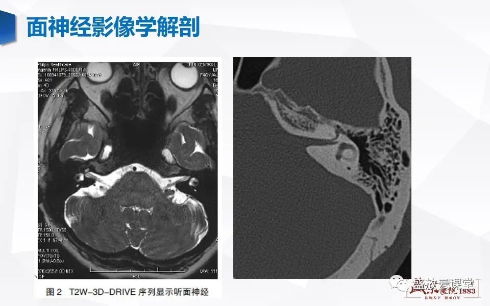 影像PPT - 【PPT】面神经MR评估-10