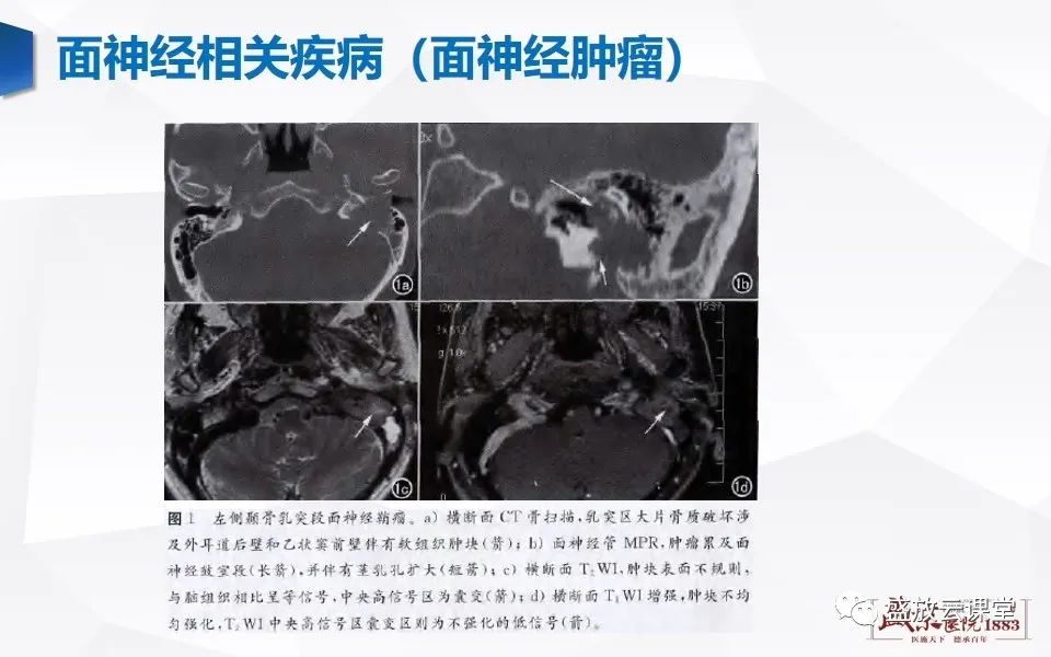 影像PPT - 【PPT】面神经MR评估-13