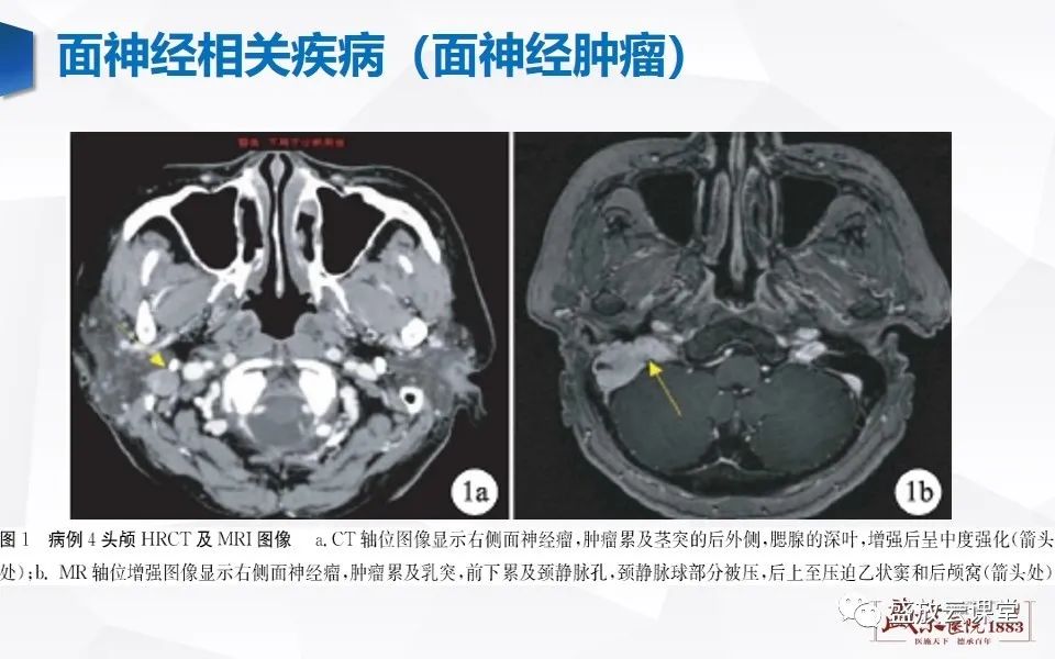 影像PPT - 【PPT】面神经MR评估-14