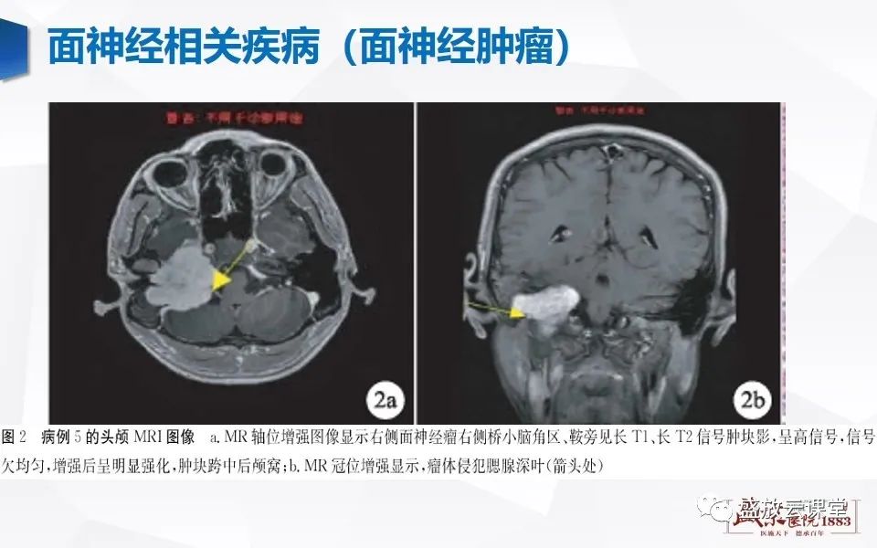 影像PPT - 【PPT】面神经MR评估-15