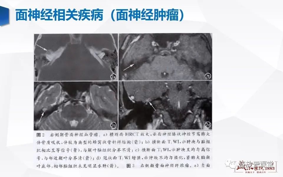 影像PPT - 【PPT】面神经MR评估-16