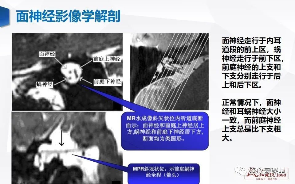 影像PPT - 【PPT】面神经MR评估-2