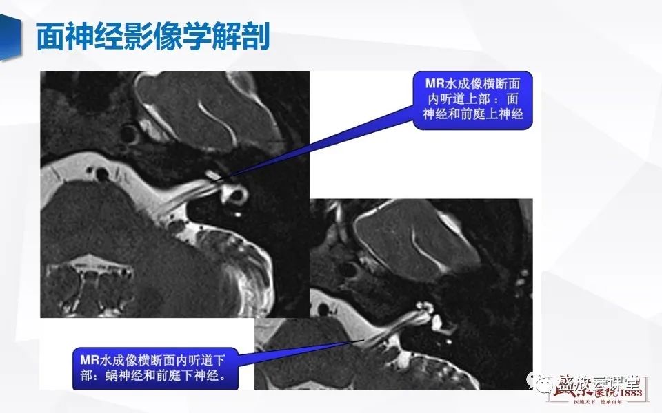 影像PPT - 【PPT】面神经MR评估-1