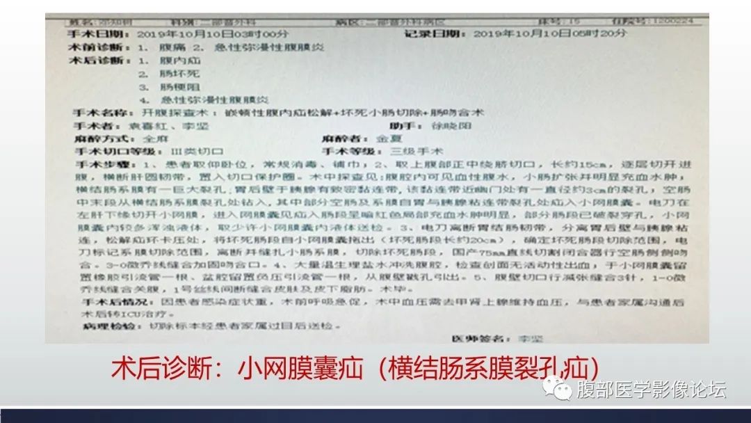 影像PPT - 【病例】腹内疝—小网膜囊疝1例CT影像-6 影像PPT - 【病例】腹内疝—小网膜囊疝1例CT影像-6