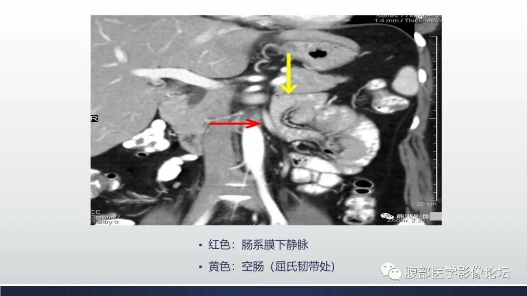 影像PPT - 【病例】腹内疝—小网膜囊疝1例CT影像-13 影像PPT - 【病例】腹内疝—小网膜囊疝1例CT影像-13