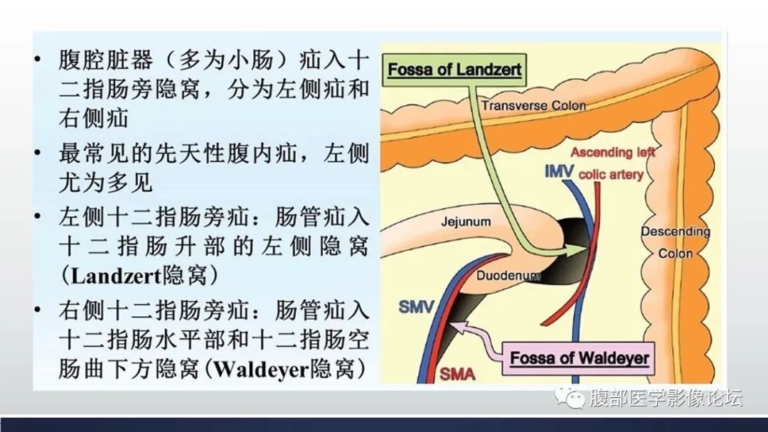 影像PPT - 【病例】腹内疝—小网膜囊疝1例CT影像-21 影像PPT - 【病例】腹内疝—小网膜囊疝1例CT影像-21