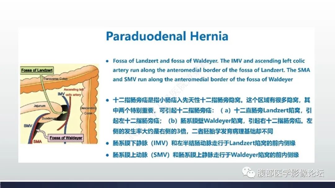 影像PPT - 【病例】腹内疝—小网膜囊疝1例CT影像-22 影像PPT - 【病例】腹内疝—小网膜囊疝1例CT影像-22