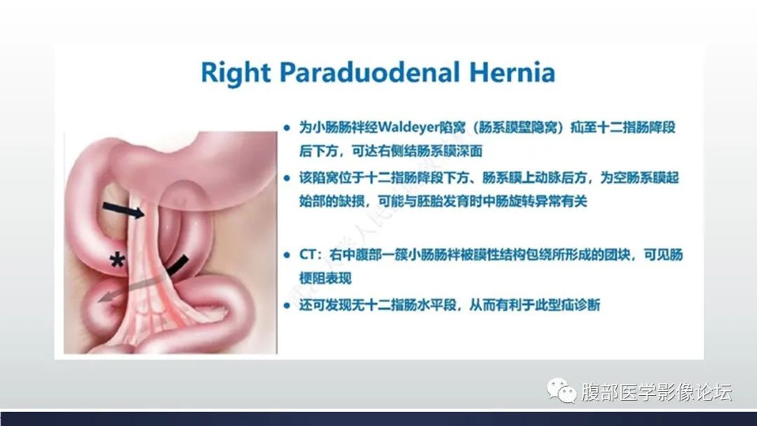 影像PPT - 【病例】腹内疝—小网膜囊疝1例CT影像-25 影像PPT - 【病例】腹内疝—小网膜囊疝1例CT影像-25