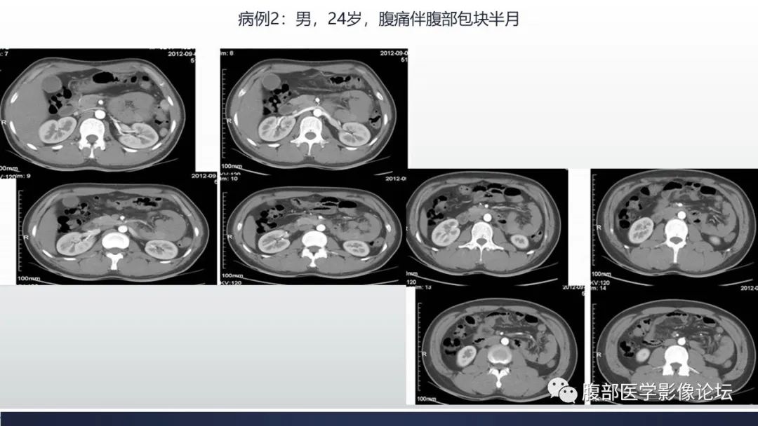 影像PPT - 【病例】腹内疝—小网膜囊疝1例CT影像-29 影像PPT - 【病例】腹内疝—小网膜囊疝1例CT影像-29