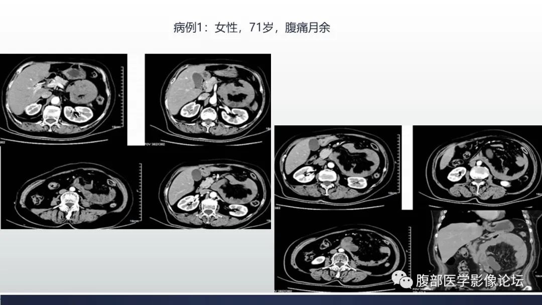 影像PPT - 【病例】腹内疝—小网膜囊疝1例CT影像-28 影像PPT - 【病例】腹内疝—小网膜囊疝1例CT影像-28