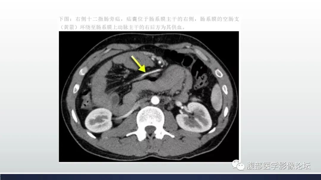 影像PPT - 【病例】腹内疝—小网膜囊疝1例CT影像-31 影像PPT - 【病例】腹内疝—小网膜囊疝1例CT影像-31