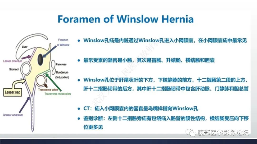 影像PPT - 【病例】腹内疝—小网膜囊疝1例CT影像-39 影像PPT - 【病例】腹内疝—小网膜囊疝1例CT影像-39