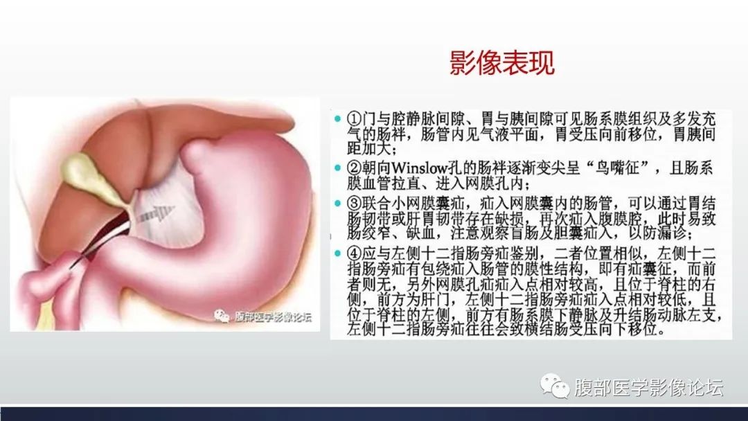 影像PPT - 【病例】腹内疝—小网膜囊疝1例CT影像-40 影像PPT - 【病例】腹内疝—小网膜囊疝1例CT影像-40