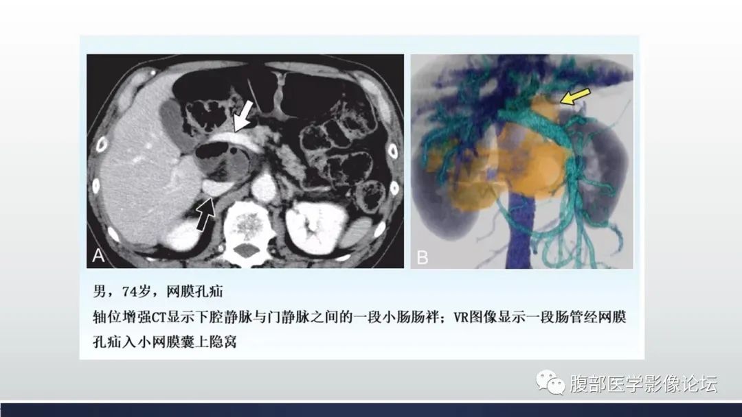 影像PPT - 【病例】腹内疝—小网膜囊疝1例CT影像-42 影像PPT - 【病例】腹内疝—小网膜囊疝1例CT影像-42