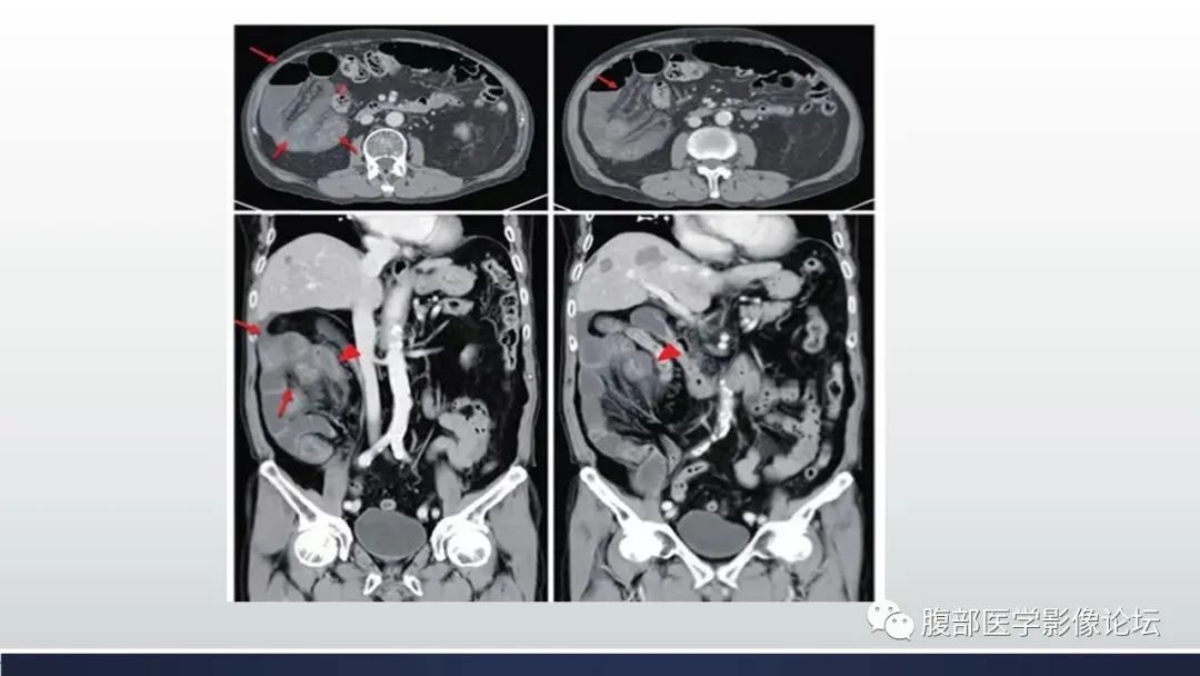 影像PPT - 【病例】腹内疝—小网膜囊疝1例CT影像-47 影像PPT - 【病例】腹内疝—小网膜囊疝1例CT影像-47