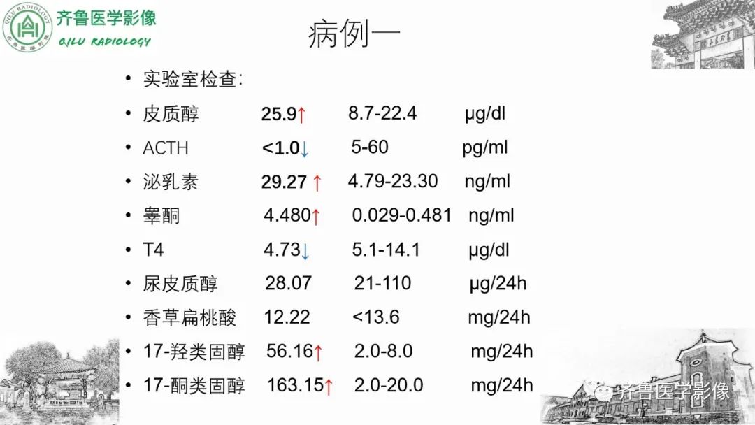 影像PPT - 【病例】肾上腺皮质腺癌2例CT及MR影像-3
