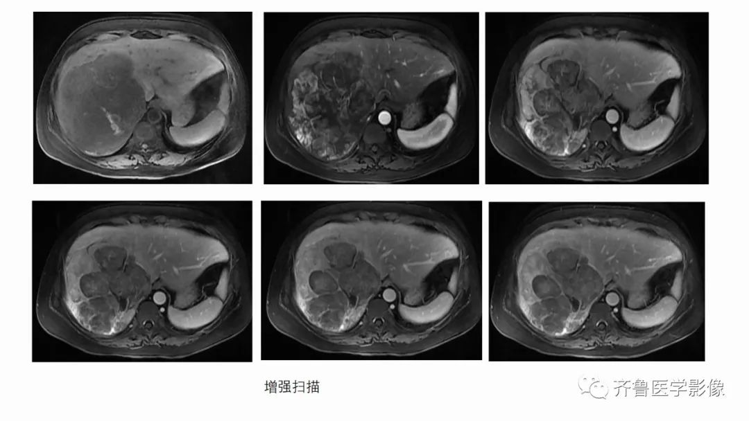 影像PPT - 【病例】肾上腺皮质腺癌2例CT及MR影像-5