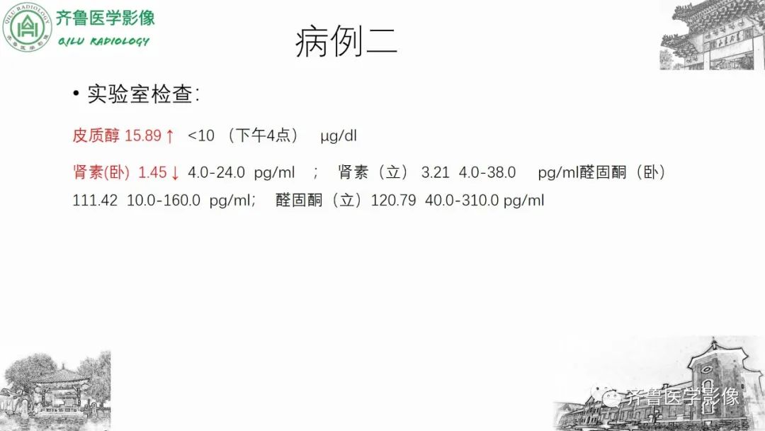 影像PPT - 【病例】肾上腺皮质腺癌2例CT及MR影像-10